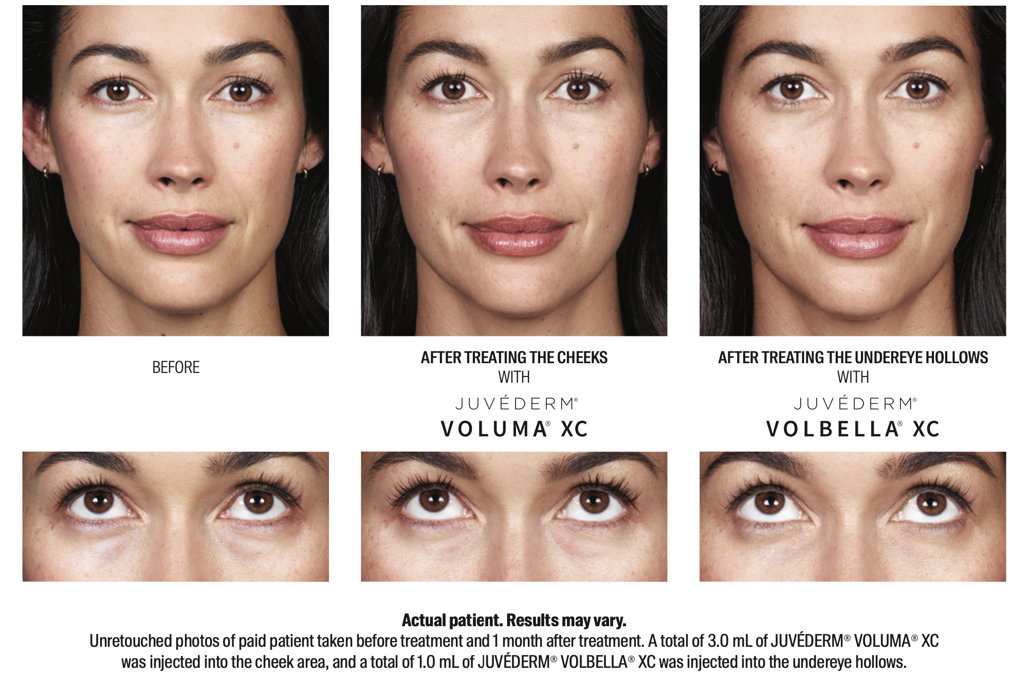 Juvederm Before and After Image